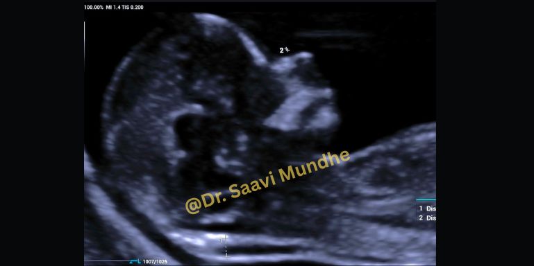 First-Trimister-Pregnacy